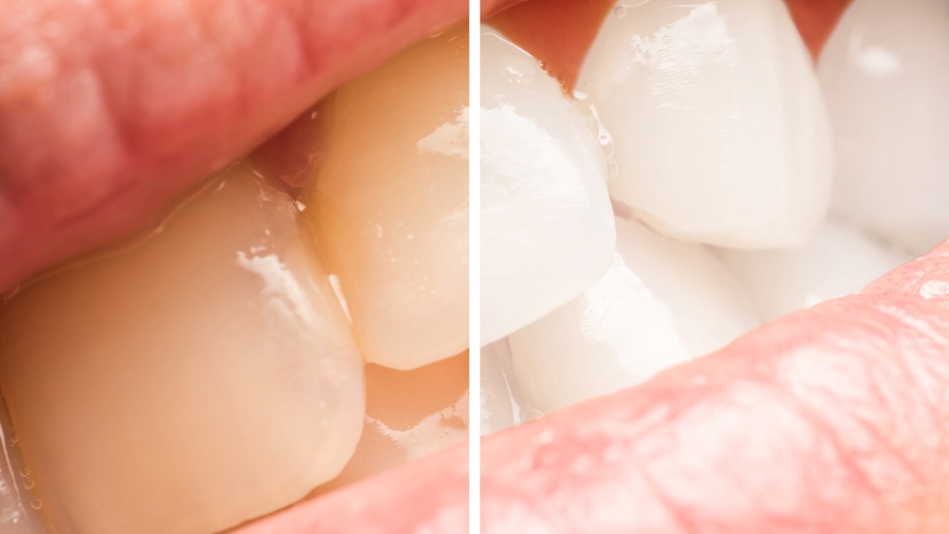 5 راه آسان برای سفید کردن دندان های زرد به طور طبیعی